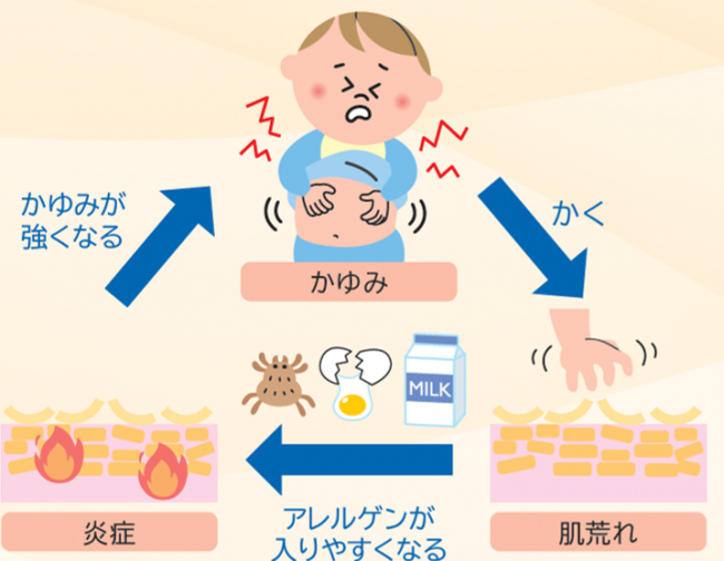 かゆみの悪循環の画像